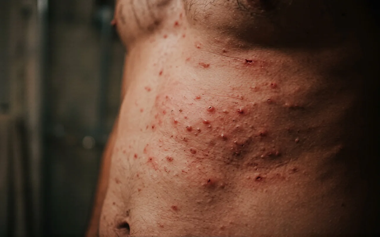 Antes — pele irritada